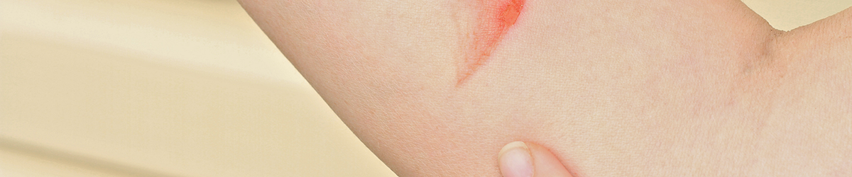 Comment soigner une brûlure superficielle ? Que faire en cas de brûlure superficielle ?